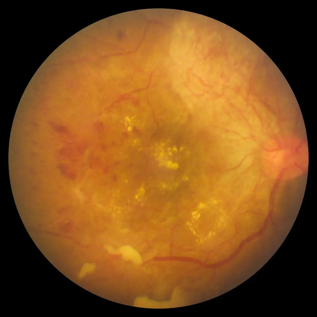 FOP_eye_fundus6.webp