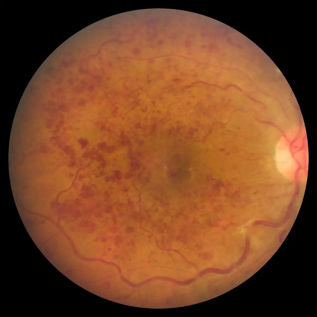 FOP_eye_fundus7.webp