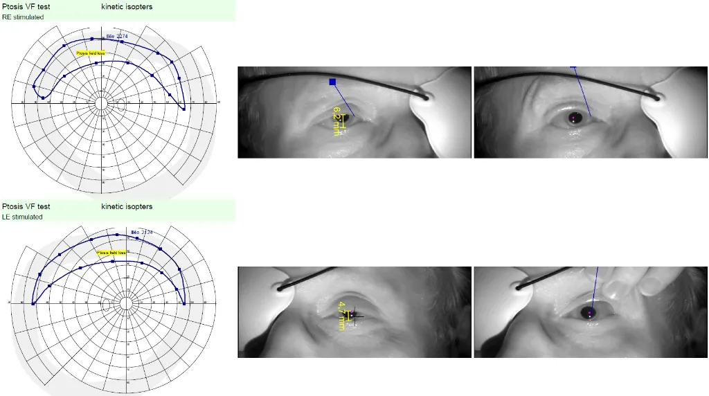 Bilan préopératoire blépharoplastie.webp